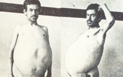 被稱「氣球人」他滿肚子大便  「1個月只拉1次」29歲時結腸被取出連醫生都震驚